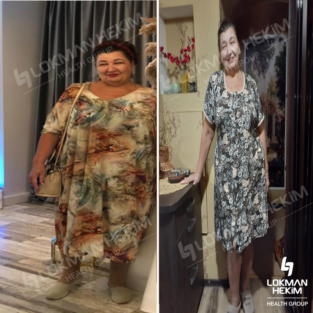 Gastric bypass surgery